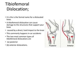 Tibiofemoral
Dislocation;
• It is the is the formal name for a dislocated
knee.
• A tibiofemoral dislocation can cause
damage to the structures that support your
knee
• caused by a direct, hard impact to the knee
• This commonly happens in car accidents
• The two most common types of
tibiofemoral dislocations are
• (a) posterior
• (b) anterior dislocations.
 
