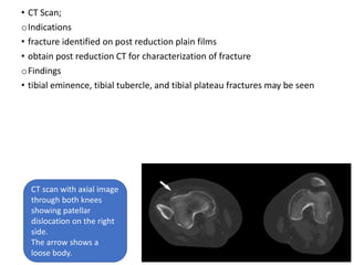 • CT Scan;
oIndications
• fracture identified on post reduction plain films
• obtain post reduction CT for characterization of fracture
oFindings
• tibial eminence, tibial tubercle, and tibial plateau fractures may be seen
CT scan with axial image
through both knees
showing patellar
dislocation on the right
side.
The arrow shows a
loose body.
 