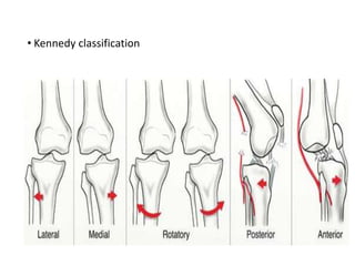 • Kennedy classification
 