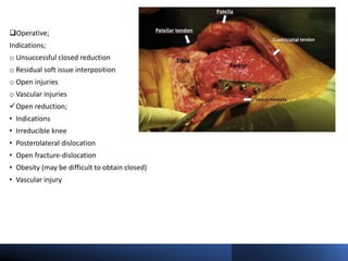 Operative;
Indications;
o Unsuccessful closed reduction
o Residual soft issue interposition
o Open injuries
o Vascular injuries
Open reduction;
• Indications
• Irreducible knee
• Posterolateral dislocation
• Open fracture-dislocation
• Obesity (may be difficult to obtain closed)
• Vascular injury
 