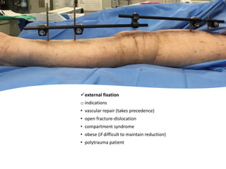 external fixation
o indications
• vascular repair (takes precedence)
• open fracture-dislocation
• compartment syndrome
• obese (if difficult to maintain reduction)
• polytrauma patient
 