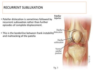 RECURRENT SUBLUXATION
• Patellar dislocation is sometimes followed by
recurrent subluxation rather than further
episodes of complete displacement.
• This is the borderline between frank instability
and maltracking of the patella
 