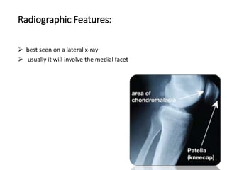 Radiographic Features:
 best seen on a lateral x-ray
 usually it will involve the medial facet
 