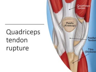 Quadriceps
tendon
rupture
 