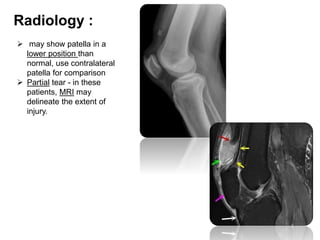 Radiology :
 may show patella in a
lower position than
normal, use contralateral
patella for comparison
 Partial tear - in these
patients, MRI may
delineate the extent of
injury.
 