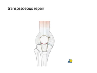 transossoeous repair
 
