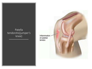 Patella
tendonitis(jumper’s
knee)
 