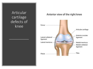 Articular
cartilage
defects of
knee
 