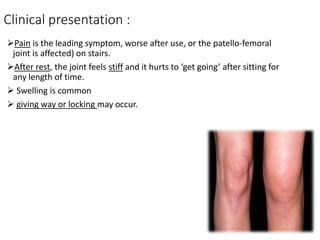 Clinical presentation :
Pain is the leading symptom, worse after use, or the patello-femoral
joint is affected) on stairs.
After rest, the joint feels stiff and it hurts to ‘get going’ after sitting for
any length of time.
 Swelling is common
 giving way or locking may occur.
 