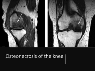 Osteonecrosis of the knee
 