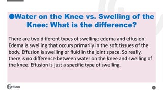 Knee effusion : Fluid Or Water On The Knee-Medical Study | PPTX