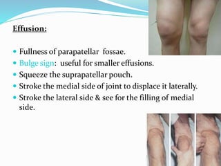 Effusion:
 Fullness of parapatellar fossae.
 Bulge sign: useful for smaller effusions.
 Squeeze the suprapatellar pouch.
 Stroke the medial side of joint to displace it laterally.
 Stroke the lateral side & see for the filling of medial
side.
 