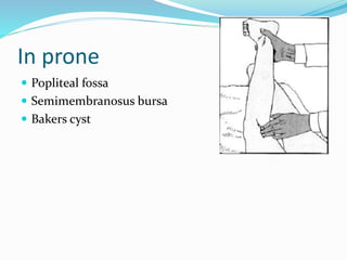 In prone
 Popliteal fossa
 Semimembranosus bursa
 Bakers cyst
 