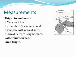Measurements
Thigh circumference
 Mark joint line.
 18 cm above(maximum bulk).
 Compare with normal knee.
 ›2cm difference is significance.
Calf circumference.
Limb length.
 