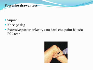 Posterior drawer test
 Supine
 Knee 90 deg
 Excessive posterior laxity / no hard end point felt s/o
PCL tear
 