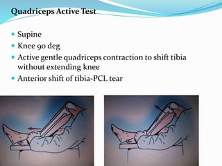Quadriceps Active Test
 Supine
 Knee 90 deg
 Active gentle quadriceps contraction to shift tibia
without extending knee
 Anterior shift of tibia-PCL tear
 