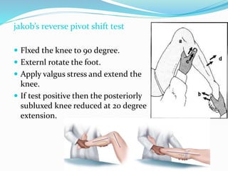 jakob’s reverse pivot shift test
 Flxed the knee to 90 degree.
 Externl rotate the foot.
 Apply valgus stress and extend the
knee.
 If test positive then the posteriorly
subluxed knee reduced at 20 degree
extension.
 