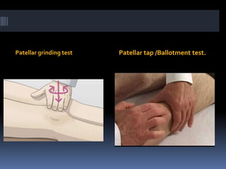 Patellar grinding test Patellar tap /Ballotment test.
 