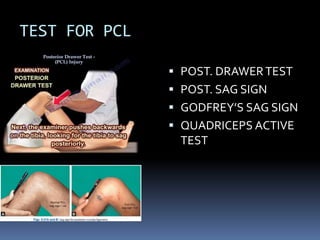 TEST FOR PCL
 POST. DRAWERTEST
 POST. SAG SIGN
 GODFREY’S SAG SIGN
 QUADRICEPS ACTIVE
TEST
 