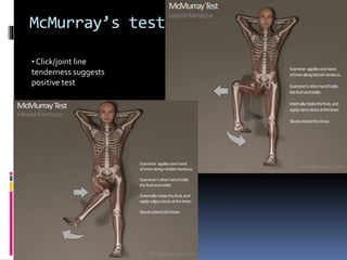 McMurray’s test
• Click/joint line
tenderness suggests
positive test
 