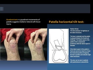 Quadrant test:>=3 quadrant movements of
patella suggests medial or lateral soft tissue
injury.
Patella horizontal tilt test:
 