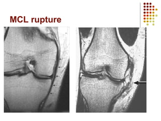 Mcl Rupture Classification KNEE INJURIES excellent slides to go.ppt
