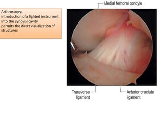 Arthroscopy:
introduction of a lighted instrument
into the synovial cavity
permits the direct visualization of
structures
 