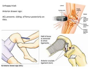 Unhappy triad:
Anterior drawer sign:
ACL prevents sliding of femur posteriorly on
tibia.
 