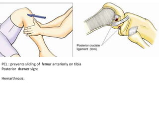 PCL : prevents sliding of femur anteriorly on tibia
Posterior drawer sign:
Hemarthrosis:
 