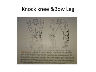 Knock knee &Bow Leg
 