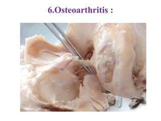 6.Osteoarthritis :
 