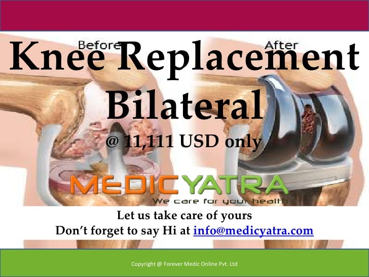 Knee replacement Bilateral surgery & Traetment MedicYatra