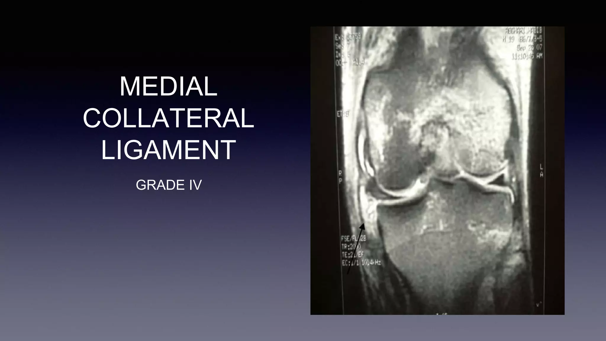 MEDIAL
COLLATERAL
LIGAMENT
GRADE IV