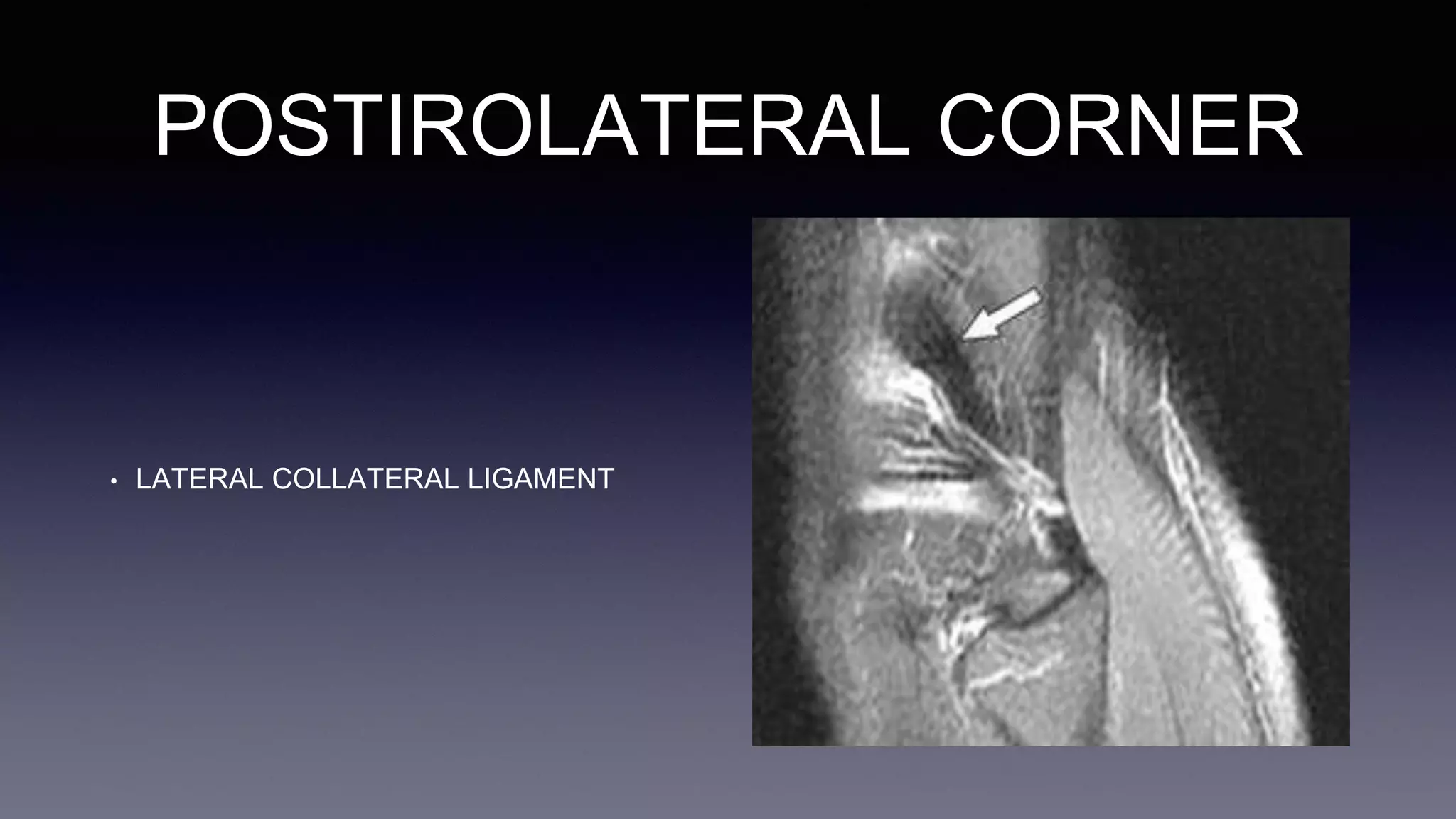 POSTIROLATERAL CORNER
• LATERAL COLLATERAL LIGAMENT