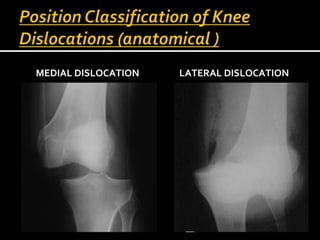 MEDIAL DISLOCATION

LATERAL DISLOCATION

 