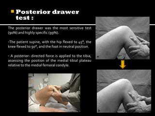  Posterior

test :

drawer

The posterior drawer was the most sensitive test
(90%) and highly specific (99%).
-The patient supine, with the hip flexed to 45°, the
knee flexed to 90°, and the foot in neutral position.
- A posterior- directed force is applied to the tibia,
assessing the position of the medial tibial plateau
relative to the medial femoral condyle.

 