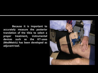 Because it is important to
accurately measure the posterior
translation of the tibia to select a
proper treatment, instrumental
devices such as the KT-1000
(MedMetric) has been developed as
adjuvant tool.

 