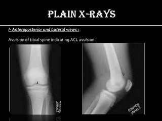 I- Anteroposterior and Lateral views :
Avulsion of tibial spine indicating ACL avulsion

 