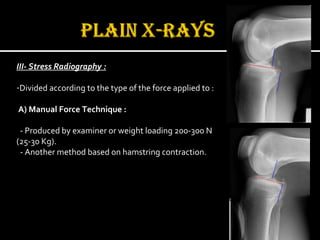 III- Stress Radiography :
-Divided according to the type of the force applied to :
A) Manual Force Technique :
- Produced by examiner or weight loading 200-300 N
(25-30 Kg).
- Another method based on hamstring contraction.

 