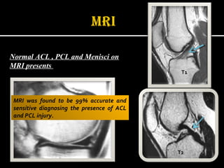 Normal ACL , PCL and Menisci on
MRI presents

T1

MRI was found to be 99% accurate and
sensitive diagnosing the presence of ACL
and PCL injury.

T2

 