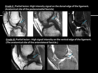 Grade II : Partial lesion: High intensity signal on the dorsal edge of the ligament.
(Anatomical site of the posteromedial fascicle)

Grade III: Partial lesion : High signal intensity on the ventral edge of the ligament.
(The anatomical site of the anterolateral fascicle.)

 