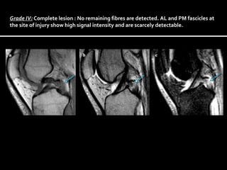 Grade IV: Complete lesion : No remaining fibres are detected. AL and PM fascicles at
the site of injury show high signal intensity and are scarcely detectable.

 