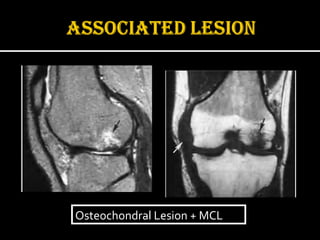 Osteochondral Lesion + MCL
Osteochondral Lesion + MCL

 