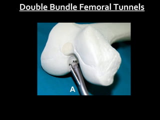 Double Bundle Femoral Tunnels

 