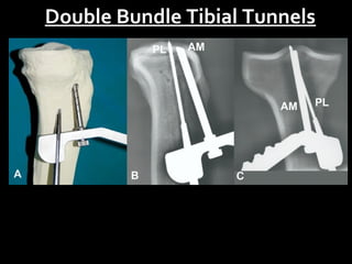 Double Bundle Tibial Tunnels

 