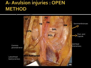 II- Direct posterior approach :

Semimembronuses

Biceps
Tibial
Femoris
nerve

Post. Joint
Capsule

Medial Head
gastrocnemeus

Common
peroneal nerve

Lateral head
Gastrocnemeus

Small
Saphenous
vein

 