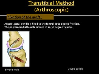 Fixation of the graft :
-Anterolateral bundle is fixed to the femrol in 90 degree frlexion.
-The posteromedial bundle is fixed in 20-30 degree flexion.

Single Bundle

Double Bundle

 