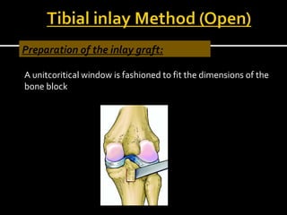 Preparation of the inlay graft:
A unitcoritical window is fashioned to fit the dimensions of the
bone block.

 
