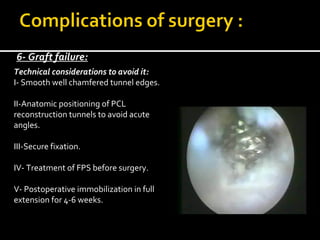 6- Graft failure:
Technical considerations to avoid it:
I- Smooth well chamfered tunnel edges.
II-Anatomic positioning of PCL
reconstruction tunnels to avoid acute
angles.
III-Secure fixation.
IV- Treatment of FPS before surgery.
V- Postoperative immobilization in full
extension for 4-6 weeks.

 