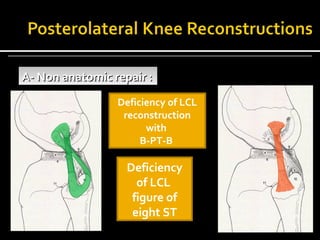 A- Non anatomic repair ::
A- Non anatomic repair
Deficiency of LCL
reconstruction
with
B-PT-B

Deficiency
of LCL
figure of
eight ST

 